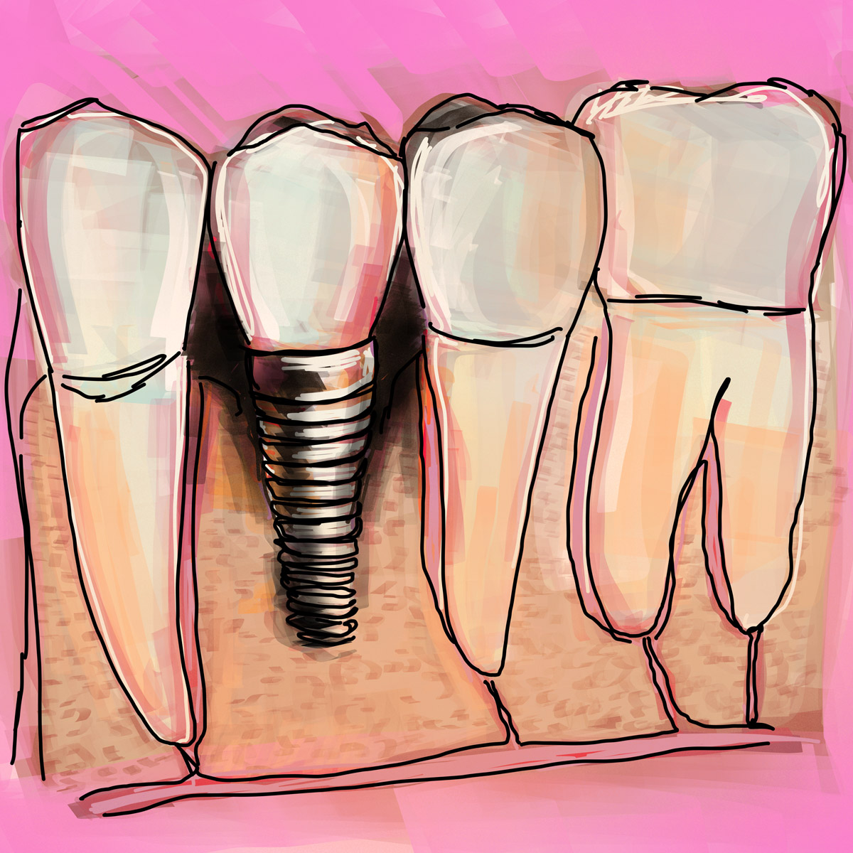 Impianti dentali in centro a Milano
