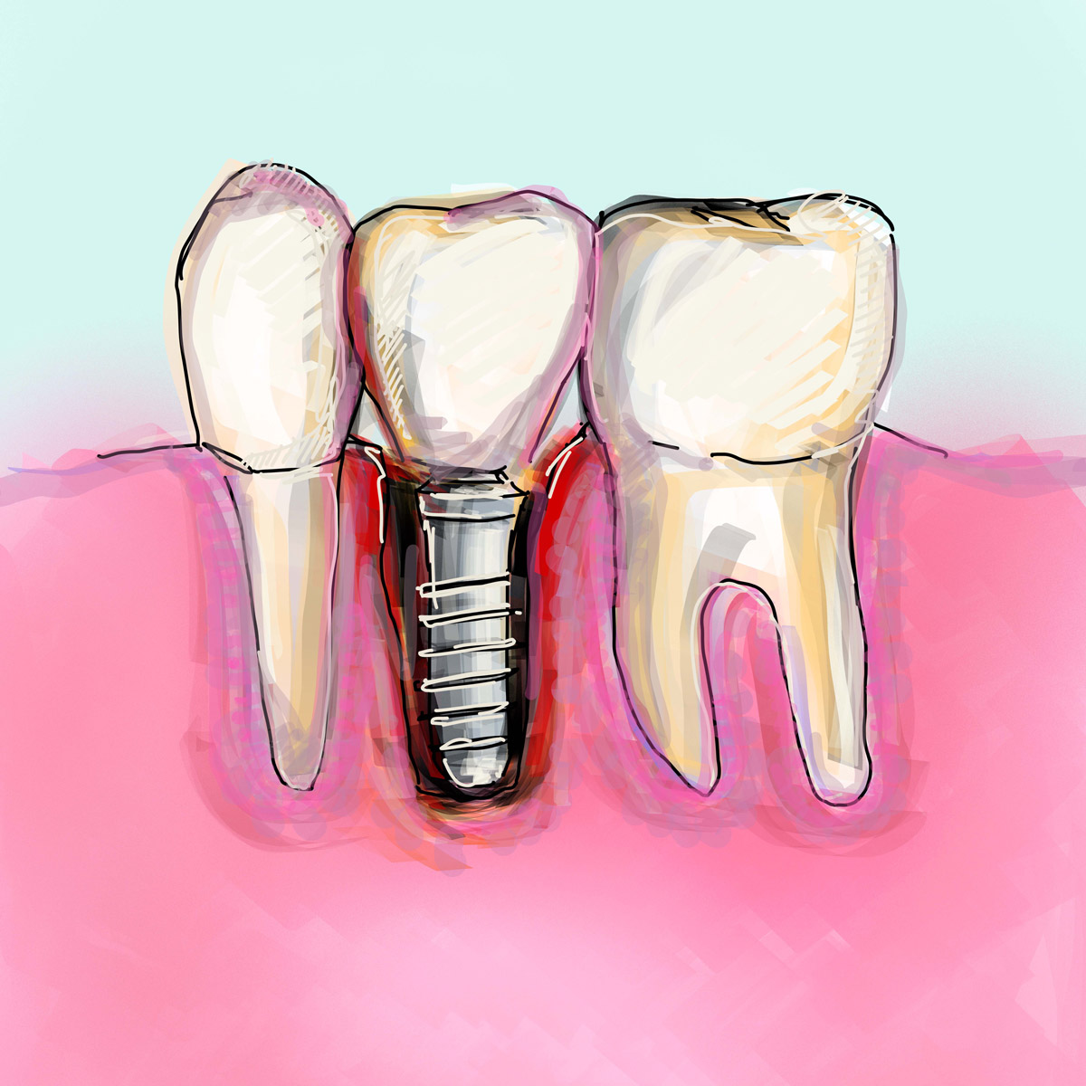 Impianti dentali in centro a Milano