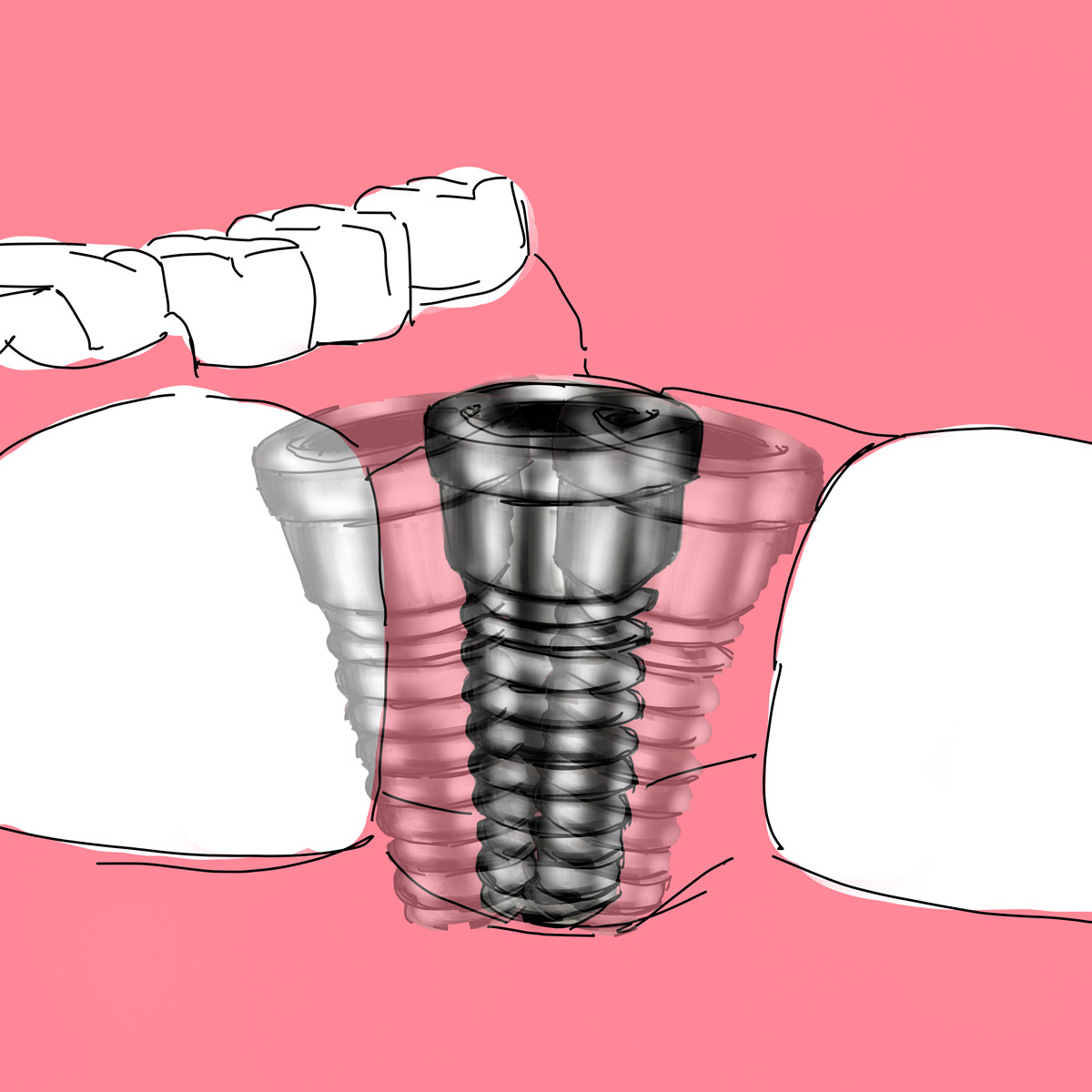 Impianti dentali in centro a Milano