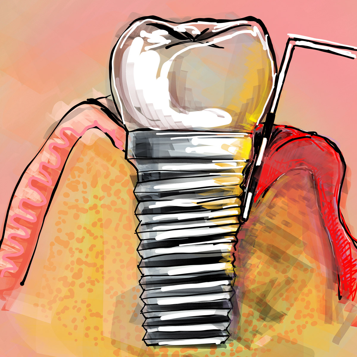 Impianti dentali in centro a Milano
