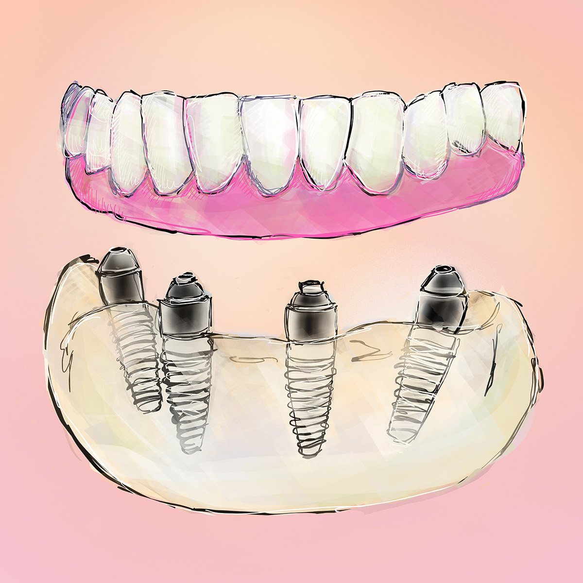 Impianti dentali All-on-4