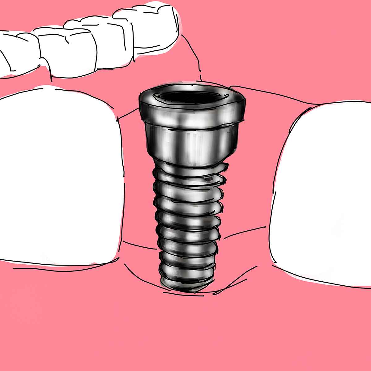Impianti dentali computer-assistiti