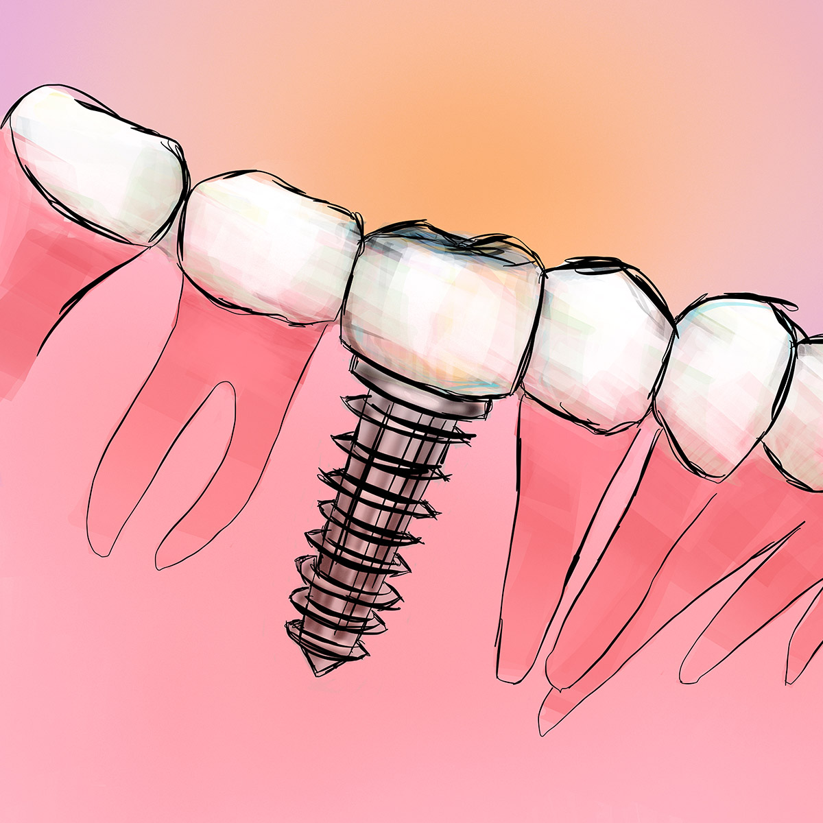 Impianti dentali con alta precisione digitale