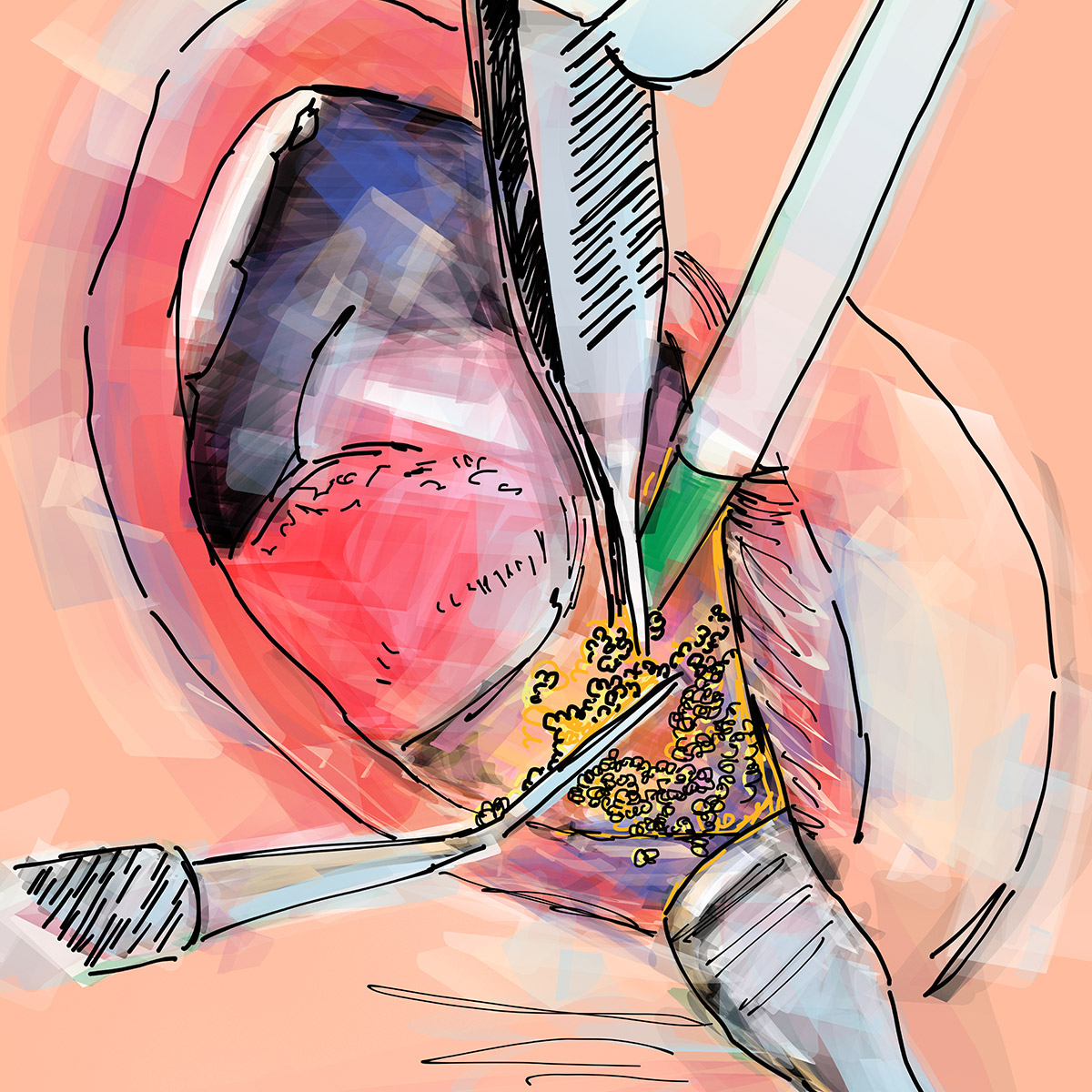 Ricostruzione dell'osso alveolare'