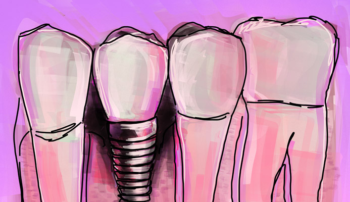 Impianti dentali in centro a Milano