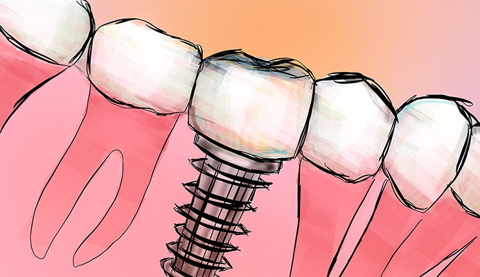 Impianti dentali in centro a Milano