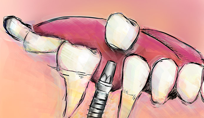 Impianti dentali in centro a Milano