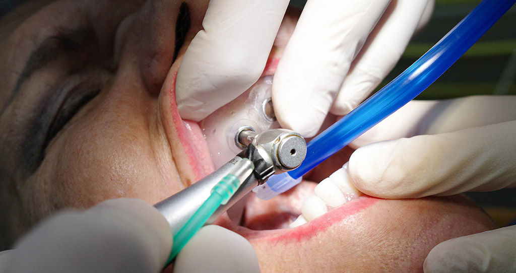 Impianti dentali in centro a Milano