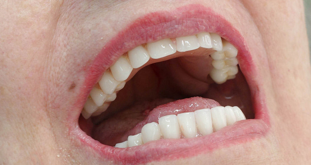 Impianti dentali in centro a Milano