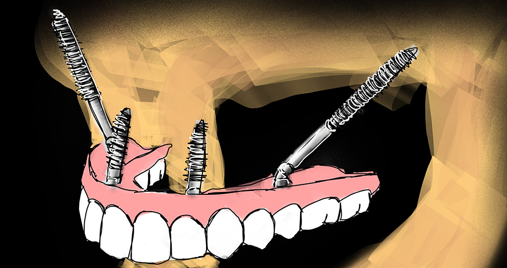 Impianti dentali in centro a Milano