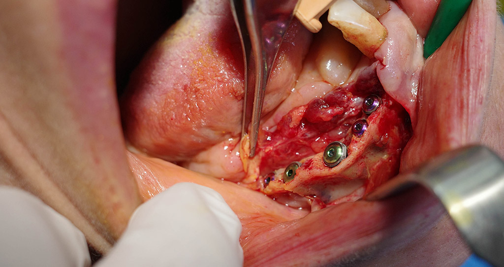 Impianti dentali in centro a Milano