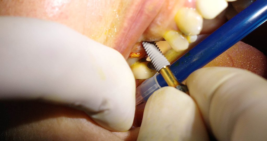 Impianti dentali in centro a Milano